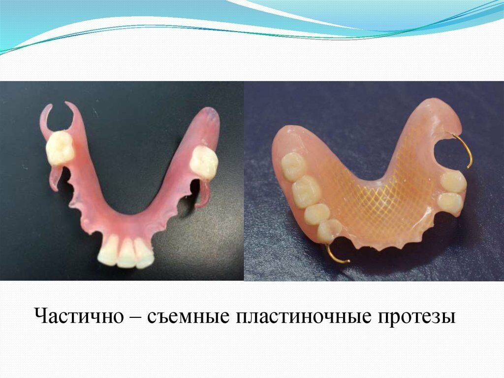 Пластиночные протезы презентация